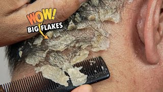 Itchy Psoriasis Scalp Scratching Big Flakes Satisfying 819 [upl. by Sunda]