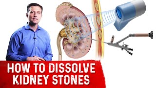 How To Dissolve Kidney Stones Explained By DrBerg [upl. by Anaya206]