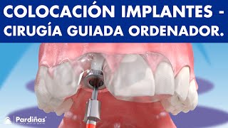 Cirugía guiada por ordenador para colocar IMPLANTES DENTALES© [upl. by Chyou631]