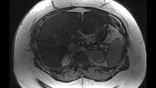 Hepatic Steatosis [upl. by Jeraldine188]