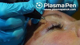 Plasma Pen  Louise Walsh International  Before amp Afters  How We Get These Results [upl. by Dabbs]