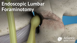 Endoscopic Lumbar Foraminotomy [upl. by Elbas]