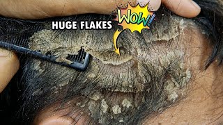 Psoriasis Scalp Scratching Huge Flakes Satisfying 735 [upl. by Outlaw]