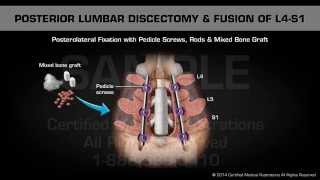 Posterior Lumbar Discectomy amp Fusion of L4S1 [upl. by Akiner]