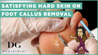 Satisfying hard skin on foot callus removal [upl. by Nirrep]