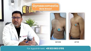 Myths amp Facts About Gynaecomastia  Symmetrica  Siliguri [upl. by Eanej]