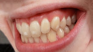 What is Dental Fluorosis  Dr Aniruddha KB [upl. by Val]