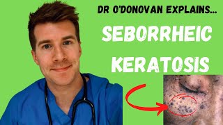 Explaining Seborrheic Keratosis  With Dr ODonovan [upl. by Fernyak]