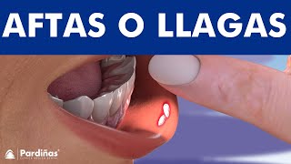 LLAGAS EN LA BOCA – Cómo curar las aftas bucales © [upl. by Irmo]