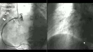 Neuro Embolization Procedure [upl. by Hurst711]