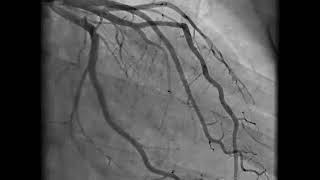 Pulmonary CT Angiogram Basics [upl. by Flosser]