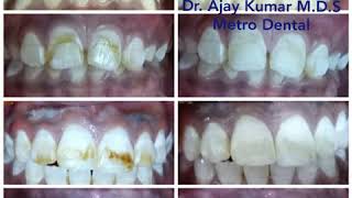 Teeth whitening Dental Bleaching  Dental fluorosis [upl. by Chancellor]