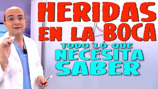 HERIDAS EN LA BOCA AFTAS ORALES  Todo lo que necesita saber  Enfermedades 10 [upl. by Nnazus]