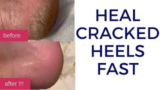 How to Quickly Heal Cracked Dry Feet amp Heels Naturally  DIY Natural Treatment for Cracked Heels [upl. by Dail]