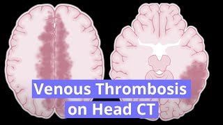 Venous Thrombosis on Head CT [upl. by Davidoff]