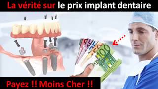 Prix implant dentaire  partie 1 [upl. by Evered]