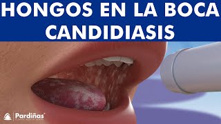 CANDIDIASIS oral y BOQUERAS  Cómo CURAR los hongos de la boca © [upl. by Robi]