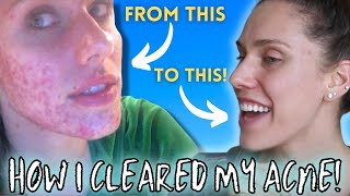 HOW I CLEARED MY ACNE  Chronic Cystic Digestive Hormonal [upl. by Ahsekar]