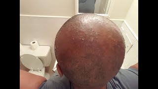 How To Cure Scalp Inflammation Bumps and Blisters  CCCA AlopeciaFolliculitis [upl. by Yendys]