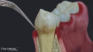 Tratamiento Periodontal Básico para pacientes [upl. by Ardnikat]