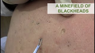 A Minefield of Blackheads  Dr Derm [upl. by Otrebogad]