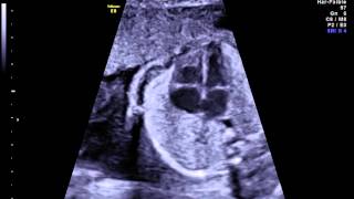 Embryology  Development of Fetal Circulation [upl. by Keyek]