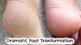 DRAMATIC FOOT TRANSFORMATION IN 10 DAYS  HOW I FIXED MY DRY CRACKED HEELS  KERRY WHELPDALE [upl. by Robena390]