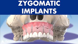 ZYGOMATIC implants  How to place dental implants without bone © [upl. by Leban]