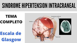 SINDROME DE HIPERTENSION INTRACRANEAL  Glasgow [upl. by Tami751]