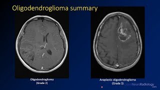 Imaging brain tumors  3  Oligodendrogliomas [upl. by Alasteir844]