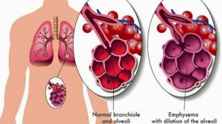 Bronchiolitis Causes Classification Symptoms Diagnosis and Treatment [upl. by Edeline831]