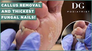 Callus removal from feet and thick toenails cutting treatment  DG Podiatrist The Foot Scraper [upl. by Sonnnie]