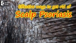 Scalp psoriasisSymptom Cause Treatment  Safe ways to Wash Hair Dr Rasya Dixit Doctors Circle [upl. by Retsehc]