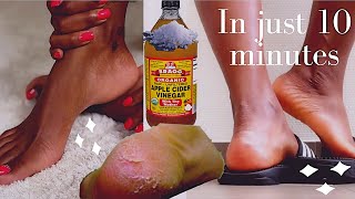 how to remove dead skin from your feet naturally at home 2021 cracked heels home remedy [upl. by Amees875]