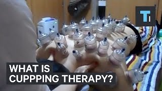 What is cupping therapy [upl. by Yarled]