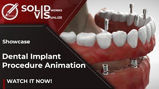 Dental Implant Procedure  Solidworks Visualize Animation [upl. by Aisekal]