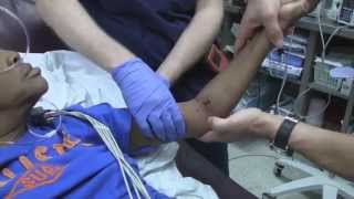 Posterior Elbow Dislocation Reduction [upl. by Leur]