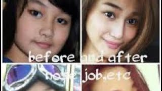 CHIENNA FILOMENO BEFORE AND AFTER PLASTIC SURGERY NAGPARETOKE NG ILONG [upl. by Imrots]