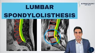 Lumbar Spondylolisthesis  Anatomy Symptoms Causes Treatments and more [upl. by Falda]