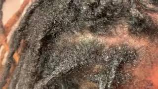 How to remove scalesdandruff or seborrheic dermatitis from the scalp [upl. by Hooge]