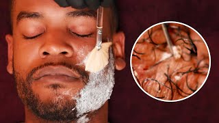 EXTREME Beard Care with SATISFYING Ingrown Hair removal [upl. by Navap]