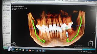 Pasos para un Implante Dental  Tomografía [upl. by Eiliak]