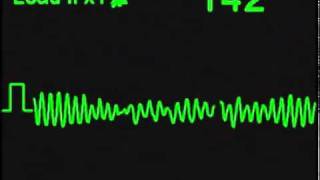 Fibrilacion Ventricular  Ventricular Fibrillation [upl. by Jarus785]