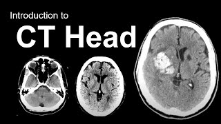 Introduction to CT Head Approach and Principles [upl. by Bernadine400]