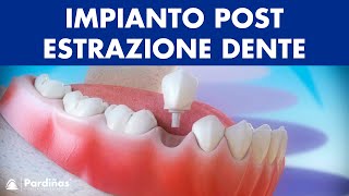 Impianto dentale immediato postestrazione dente © [upl. by Calvina808]