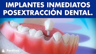 Implantes dentales inmediatos posextracción dental © [upl. by Eelrihs35]