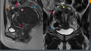 Diagnostico por imágenes Patología miometrial y endometrial [upl. by Ximenes649]