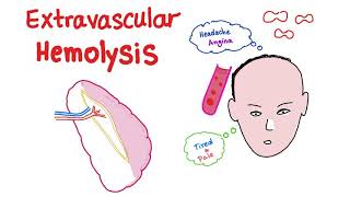 Extravascular Hemolysis [upl. by Lurleen]