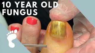 Fungus Takes Over Toenail  Toenail Removal [upl. by Ennaeed]