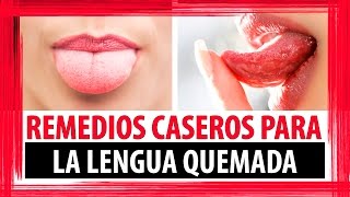 REMEDIOS CASEROS PARA LENGUA QUEMADA  COMO CURAR LA LENGUA QUEMADA [upl. by Nasya]